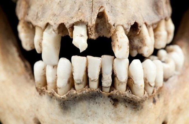Orta Çağ'da ölü askerlerin dişlerinden protezler yapılırdı.