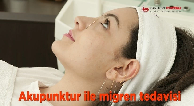 Akupunktur ile migren tedavisi