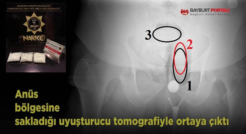 Anüs bölgesine sakladığı uyuşturucu tomografiyle ortaya çıktı